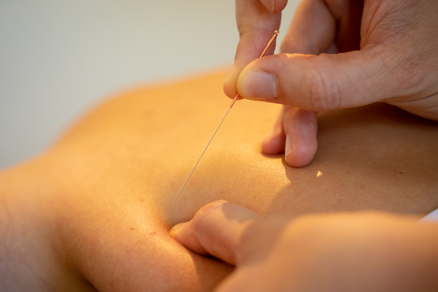 Dry needling